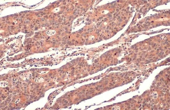 Immunohistochemistry-Paraffin: RRM1 Antibody [NBP2-20231] - RRM1 antibody detects RRM1 protein at cytoplasm by immunohistochemical analysis.Sample: Paraffin-embedded human colon cancer.RRM1 stained by RRM1 antibody (NBP2-20231) diluted at 1:500.Antigen Retrieval: Citrate buffer, pH 6.0, 15 min