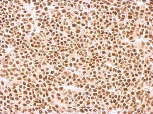SF2 antibody detects SFRS1 protein at nucleus on BT483 xenograft by immunohistochemical analysis. Sample: Paraffin-embedded BT483 xenograft. SF2 antibody (NBP2-20324) dilution: 1:500. br>Antigen Retrieval: Trilogy(TM) (EDTA based, pH 8.0) buffer, 15min 