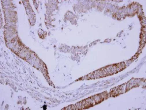 Immunohistochemical analysis of paraffin-embedded human colon carcinoma, using SH3BP5(NBP2-20343) antibody at 1:250 dilution. br>Antigen Retrieval: Trilogy(TM) (EDTA based, pH 8.0) buffer, 15min 