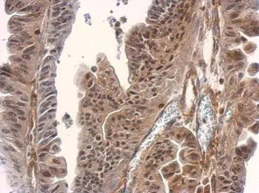 SMAD2 / SMAD3 antibody detects SMAD2 / SMAD3 protein at cytosol and nucleus on human gastric cancer by immunohistochemical analysis. Sample: Paraffin-embedded gastric cancer. SMAD2 / SMAD3 antibody (NBP2-20411) dilution: 1:500. br>Antigen Retrieval: Trilogy(TM) (EDTA based, pH 8.0) buffer, 15min 