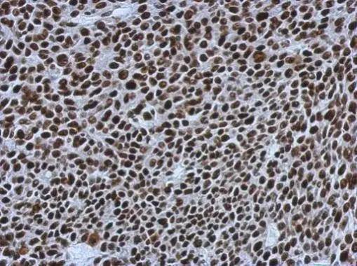 Immunohistochemical analysis of paraffin-embedded BT483 xenograft, using SMARCC1(NBP2-20415) antibody at 1:500 dilution. br>Antigen Retrieval: Trilogy(TM) (EDTA based, pH 8.0) buffer, 15min 