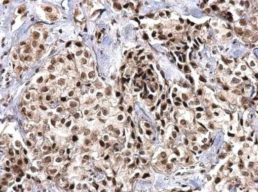 SNRPD2 antibody detects SNRPD2 protein at nucleus on human breast carcinoma by immunohistochemical analysis. Sample: Paraffin-embedded human breast carcinoma. SNRPD2 antibody (NBP2-20438) dilution: 1:500.Antigen Retrieval: Trilogy(TM) (EDTA based, pH 8.0) buffer, 15min 