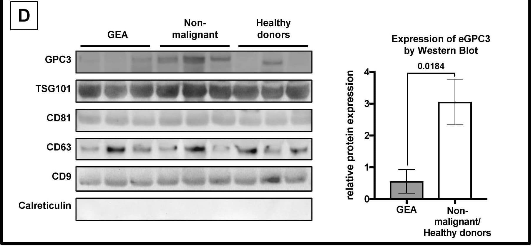 Decreased expression levels of eGPC3 in patients with gastro-esophageal adenocarcinomas (GEA). (A) Nanoparticle tracking analysis (NTA) diagram of nanoparticle concentration and average particle size from serum samples of patients with GEA (n = 9; blue line), healthy donors (n = 9; red line) and patients with non-malignant disease (n = 9; green line). (B) Transmission electron microscopy (TEM) images of serum derived vesicles (black arrowheads). (C) Quantification of exosome-associated proteins CD9, CD63 and TSG101 determined by fluorescent NTA (p < 0.05, two-paired student´s t-test). (D) Protein expression analyses of exosome-derived GPC3, TSG101, CD81, CD63, and CD9. Calreticulin was used as a marker for cytoplasm-derived contamination (bottom panel). Representative quantification of GPC3 levels of serum-derived exosomes from patients with GEA compared to serum-derived exosomes from healthy donors and patients with non-malignant disease (right panel, p < 0.05 two-paired student´s t-test). Image collected and cropped by CiteAb from the following open publication (//pubmed.ncbi.nlm.nih.gov/31100935), licensed under a CC-BY license. Not internally tested by Novus Biologicals.