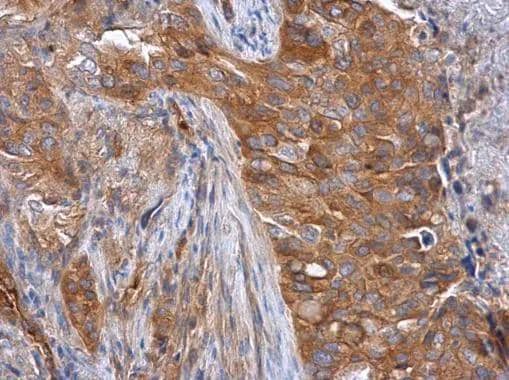 Tara antibody [C2C3-2], C-term detects Tara protein at cytoplasm in human lung cancer by immunohistochemical analysis. Sample: Paraffin-embedded human lung cancer. Tara antibody [C2C3-2], C-term (NBP2-20726) diluted at 1:500. br>Antigen Retrieval: Citrate buffer, pH 6.0, 15 min 