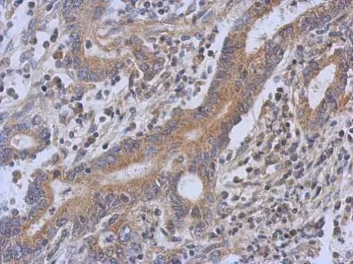 Immunohistochemistry: TRIT1 Antibody [NBP2-20727] - Immunohistochemical analysis of paraffin-embedded human colon carcinoma, using TRIT1(NBP2-20727) antibody at 1:500 dilution.Antigen Retrieval: Trilogy™ (EDTA based, pH 8.0) buffer, 15min