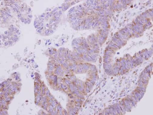 Immunohistochemistry: VARS Antibody [NBP2-20843] - VARS antibody [N1N2], N-term detects VARS protein at cytoplasm on human colon carcinoma by immunohistochemical analysis. Sample: Paraffin-embedded colon carcinoma. VARS antibody [N1N2], N-term (NBP2-20843) dilution: 1:500.Antigen Retrieval: Trilogy™ (EDTA based, pH 8.0) buffer, 15min