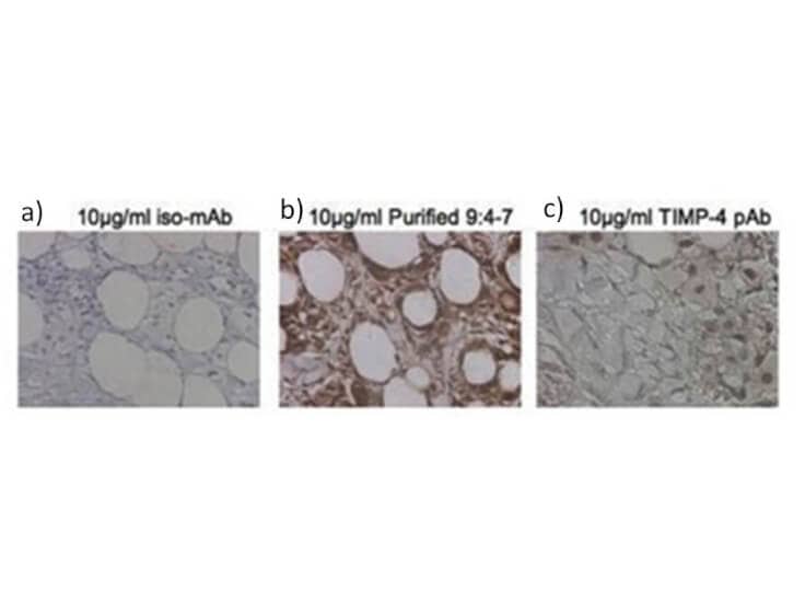 Immunohistochemistry of Mouse Anti-TIMP-4 Antibody (9:4-7).  Tissue: human breast carcinoma.  Fixation: formalin fixed paraffin embedded.  Antigen retrieval: not required. Primary antibody: a) isotype specific IgG2bk monoclonal; b) monoclonal TIMP-4 antibody (clone 9:4-7); and c) polyclonal TIMP-4, each at 10 ug/mL. Secondary antibody: Peroxidase secondary antibody at 1:10,000 for 45 min at RT. Localization: TIMP-4 is secreted. Staining: TIMP-4 as precipitated brown signal.