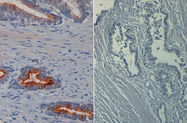 Immunohistochemistry of mouse anti AKT phospho S473 biotin conjugated. Tissue: prostate at 40X (left) with negative control (right). Fixation: FFPE buffered formalin 10% conc. Antigen retrieval: Heat, Citrate pH 6.2. Pressure Cooker. Primary antibody: AKT pS473 biotin at 20 ug/mL for 1 h at RT. Secondary antibody: Streptavidin Conj. HRP at 10 ug/ml. Localization: nuclear and occasionally cytoplasmic. Staining: antibody as precipitated red signal with a hematoxylin purple nuclear counterstain.