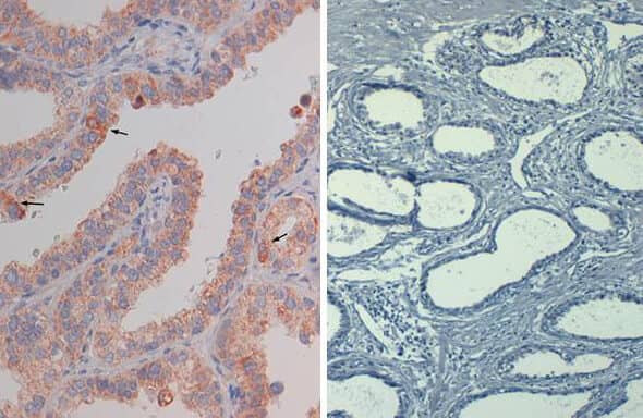 Immunohistochemistry of mouse Anti-AKT pS473 (MOUSE) Biotin Conjugated.  Tissue: prostate at 40X.  Fixation: FFPE buffered formalin 10% conc. Antigen retrieval: Heat, Citrate pH 6.2. Pressure Cooker, left. (pH 9 shown on right as negative control).  Primary antibody: AKTsS473 biotin 20 ug/mL for 1 h at RT. Secondary antibody: Streptavidin Conj. HRP at 10 ug/ml. Localization: nuclear and occasionally cytoplasmic. Staining: antibody as precipitated red signal with a hematoxylin purple nuclear counterstain.