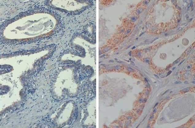 Immunohistochemistry of Mouse Anti-AKT phospho T308 Biotin Conjugated. Tissue: prostate at 20X (left) and 40X (right). Fixation: FFPE buffered formalin 10% conc. Antigen retrieval: Heat, Citrate pH 6.2. Pressure Cooker , Heat, EDTA pH 9.5 Pressure Cooker. Primary antibody: AKT pT308 biotin at 20 ug/mL for 1 h at RT. Secondary antibody: Streptavidin Conj. HRP at 10 ug/ml. Localization: nuclear and occasionally cytoplasmic. Staining: antibody as precipitated red signal with a hematoxylin purple nuclear counterstain.