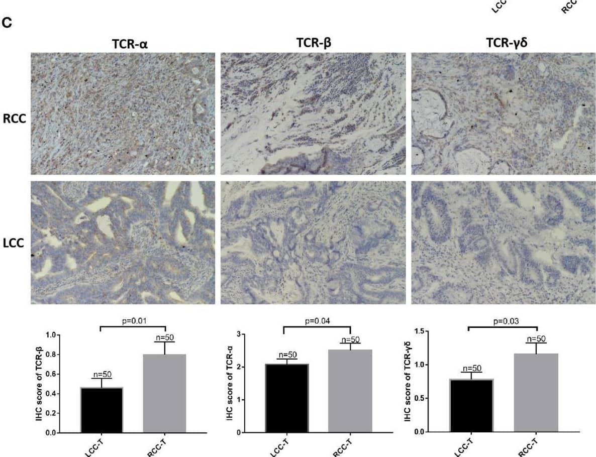 High HLA-DQA1 expression in RCC promotes antigen presentation and cytotoxic activity. The IHC images were taken at ×200 magnification. (A) Differential analysis of TIICs showed that CD4+ T, CD8+ T and macrophages M1 were more expressed in RCC, while macrophages M0 was more expressed in LCC. (B) CD83, a marker of mature DCs, was used for IHC staining and it was highly expressed in tumor tissues of RCC but not LCC. (C) TCR alpha  beta  and TCR gamma δ were both more expressed in RCC than in LCC. Image collected and cropped by CiteAb from the following open publication (//pubmed.ncbi.nlm.nih.gov/35936748), licensed under a CC-BY license. Not internally tested by Novus Biologicals.