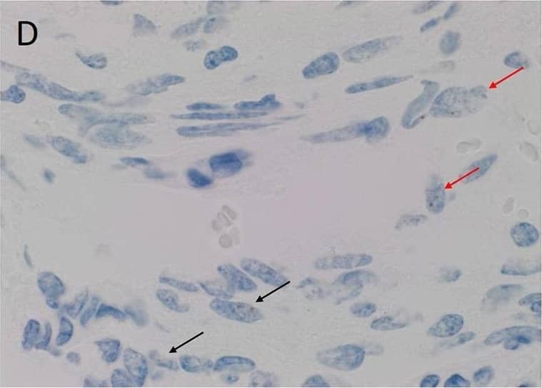 Immunohistochemistry-Paraffin: KLF4 Antibody [NBP2-24749] - Representative colorimetric in situ hybridization stained images of WHO grade I meningioma demonstrating mRNA transcript expression for OCT4 (A, brown), NANOG (B, brown), SOX2 (C, brown), KLF4 (D, brown) & c-MYC (E, brown). Nuclei were counterstained with hematoxylin (A-E, blue). Orignal magnification: 1,000X. Image collected & cropped by CiteAb from the following publication (//pubmed.ncbi.nlm.nih.gov/30417000), licensed under a CC-BY license. Not internally tested by Novus Biologicals.