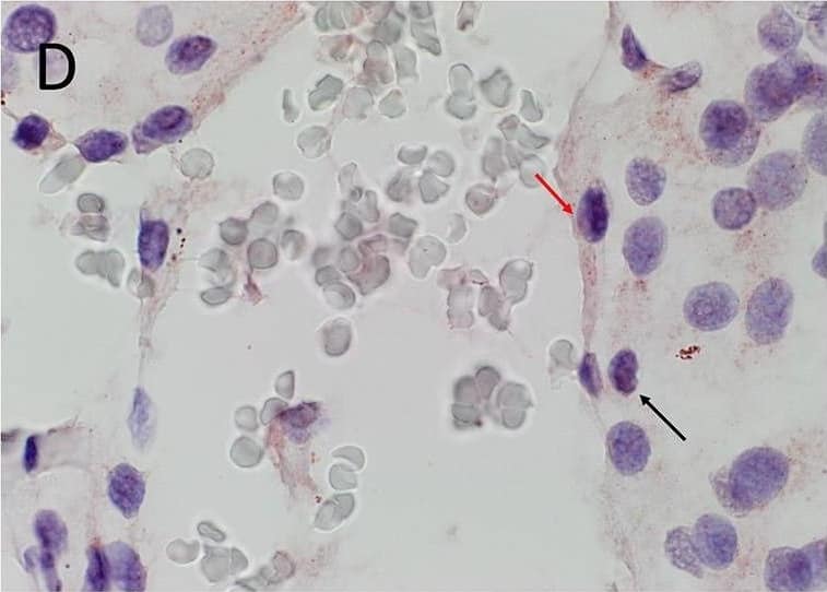 Immunohistochemistry-Paraffin: KLF4 Antibody [NBP2-24749] - Representative 3,3-diaminobenzidine immunohistochemical stained images of WHO grade I meningioma for OCT4 (A, brown), NANOG (B, purple), SOX2 (C, brown), KLF4 (D, purple) & c-MYC (E, brown) expressed on the endothelial (red arrows) & pericyte (black arrows) layers. Cell nuclei were counterstained with hematoxylin (A-E, blue). Original magnification: 400X. Image collected & cropped by CiteAb from the following publication (//pubmed.ncbi.nlm.nih.gov/30417000), licensed under a CC-BY license. Not internally tested by Novus Biologicals.