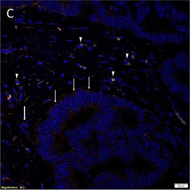 Immunocytochemistry/ Immunofluorescence: KLF4 Antibody [NBP2-24749] - Representative immunofluorescence immunohistochemical-stained sections of colon adenocarcinoma metastasis to the liver showing the expression of SOX2 [(A,D), red], NANOG [(B,E), red], KLF4 [(C,F), red], & c-Myc [(D–F), green] on the cells within the tumor nests (TNs) [(A–F), thin arrows] & those within the peritumoral stroma [(A–F), arrowheads]. OCT4 [(A–C), green] was expressed on the SOX2+ [(A), green, arrowheads], NANOG+ [(B), green, arrowheads], & KLF4+ [(C), green, arrowheads] cells within the peritumoral stroma. There were also cells within the peritumoral stroma that expressed SOX2 [(A), red, thick arrows], NANOG [(B), red, thick arrows] & KLF4 [(C), red, thick arrows] that did not express OCT4. c-Myc was expressed by cells within the TNs [(D–F), green, arrows] & those within the peritumoral stroma [(D–F), arrowheads]. The c-Myc+ population within the peritumoral stroma also expressed SOX2 [(D), red], NANOG [(E), red], & KLF4 [(F), red]. Cell nuclei were counterstained with 4′,6′-diamidino-2-phenylindole [(A–F), blue]. Scale bars: 20 µm. Image collected & cropped by CiteAb from the following publication (//journal.frontiersin.org/article/10.3389/fsurg.2017.00076/full), licensed under a CC-BY license. Not internally tested by Novus Biologicals.