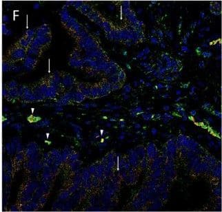 Immunocytochemistry/ Immunofluorescence: KLF4 Antibody [NBP2-24749] - Representative immunofluorescence immunohistochemical-stained sections of colon adenocarcinoma metastasis to the liver showing the expression of SOX2 [(A,D), red], NANOG [(B,E), red], KLF4 [(C,F), red], & c-Myc [(D–F), green] on the cells within the tumor nests (TNs) [(A–F), thin arrows] & those within the peritumoral stroma [(A–F), arrowheads]. OCT4 [(A–C), green] was expressed on the SOX2+ [(A), green, arrowheads], NANOG+ [(B), green, arrowheads], & KLF4+ [(C), green, arrowheads] cells within the peritumoral stroma. There were also cells within the peritumoral stroma that expressed SOX2 [(A), red, thick arrows], NANOG [(B), red, thick arrows] & KLF4 [(C), red, thick arrows] that did not express OCT4. c-Myc was expressed by cells within the TNs [(D–F), green, arrows] & those within the peritumoral stroma [(D–F), arrowheads]. The c-Myc+ population within the peritumoral stroma also expressed SOX2 [(D), red], NANOG [(E), red], & KLF4 [(F), red]. Cell nuclei were counterstained with 4′,6′-diamidino-2-phenylindole [(A–F), blue]. Scale bars: 20 µm. Image collected & cropped by CiteAb from the following publication (//journal.frontiersin.org/article/10.3389/fsurg.2017.00076/full), licensed under a CC-BY license. Not internally tested by Novus Biologicals.