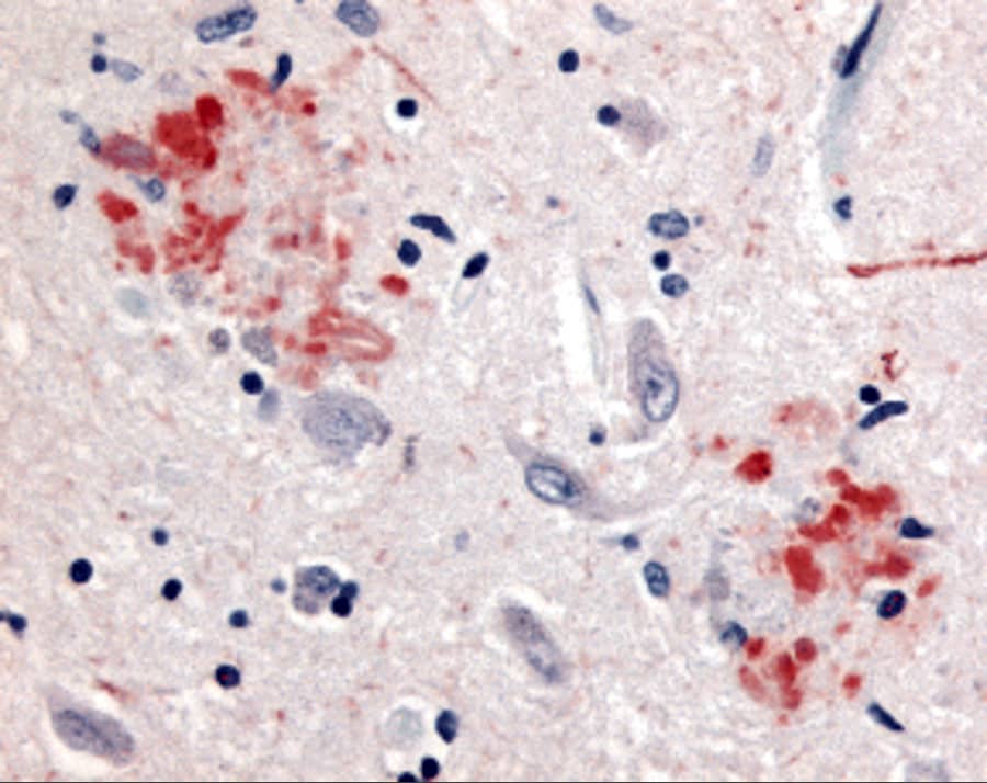 Immunohistochemistry: beta Amyloid Antibody - BSA Free [NBP2-25093] - Immunohistochemistry of beta Amyloid in human brain (Alzheimer's disease) tissue with beta Amyloid antibody at 10 ug/mL.