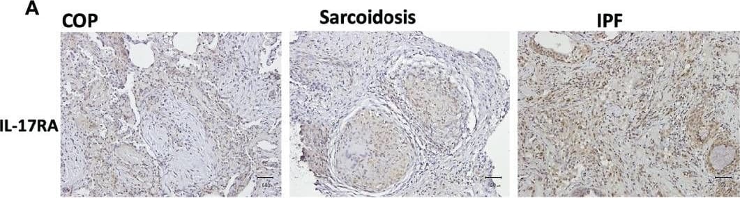 IL-17RA expression in ILD lungs. (A) Representative immunohistochemical image of lung specimens from subjects with COP, sarcoidosis and IPF. Magnification ×200. (B, C) Immunohistochemical staining showed no significant difference in IL-17RA expression amongst lung specimens from patients with COP, sarcoidosis and IPF. (D, E) The correlation between IL-17RA expression and IL-17 expression in ILDs. IL-17, interleukin-17; IL-17RA, interleukin-17 receptor A; IPF, idiopathic pulmonary fibrosis; COP, cryptogenic organizing pneumonia; OD, opacity density score; **p < 0.01. Image collected and cropped by CiteAb from the following open publication (//pubmed.ncbi.nlm.nih.gov/35865549), licensed under a CC-BY license. Not internally tested by Novus Biologicals.