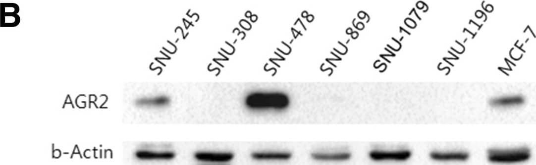 Western Blot: AG-2/AGR2 Antibody [NBP2-27393] - AGR2 expression in cancer cell lines of the biliary tract. A. AGR2 mRNA levels in six biliary tract cancer cell lines were measured by real-time RT-PCR. The AGR2 transcript levels were normalized against those of the GAPDH. Results shown are means ± standard deviations of (1/2)CT of target - CT of GAPDH of three experiments. B. AGR2 protein expression was detected by western blot analysis with  beta -actin as a loading control. The result shown is a representative of three experiments. Abbreviations: CBD, common bile duct; GB, gall bladder; AoV, ampulla of Vater; IHD, intrahepatic duct; HDB, hepatic duct bifurcation; WD, well differentiated; MD, moderately differentiated; PD, poorly differentiated [24]. Image collected & cropped by CiteAb from the following publication (//bmccancer.biomedcentral.com/articles/10.1186/1471-2407-14-804), licensed under a CC-BY license. Not internally tested by Novus Biologicals.