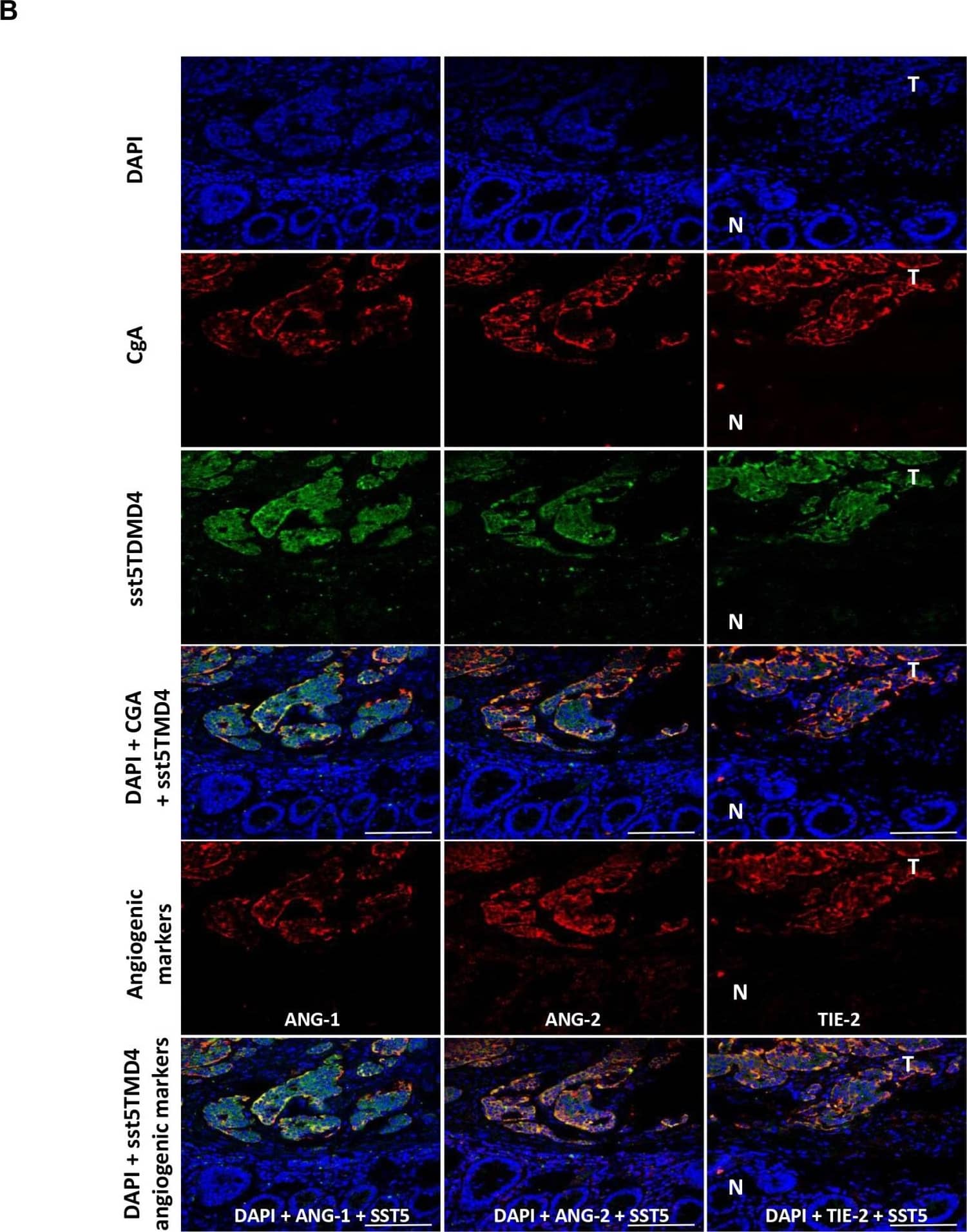 Expression of sst5TMD4 and co-localization with angiogenic marker in GEP-NET(A) Analysis of expression of angiogenic molecules and sst5TMD4 by specific serial immunohistochemistry in a pancreatic NET. Original magnification ×100 and ×400 (insets). N: normal tissue; T: tumor tissue. For specific immunostaining techniques see the “Materials and methods