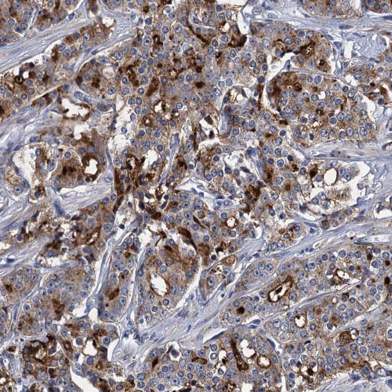 Staining of human prostate cancer shows strong cytoplasmic positivity in tumor cells.