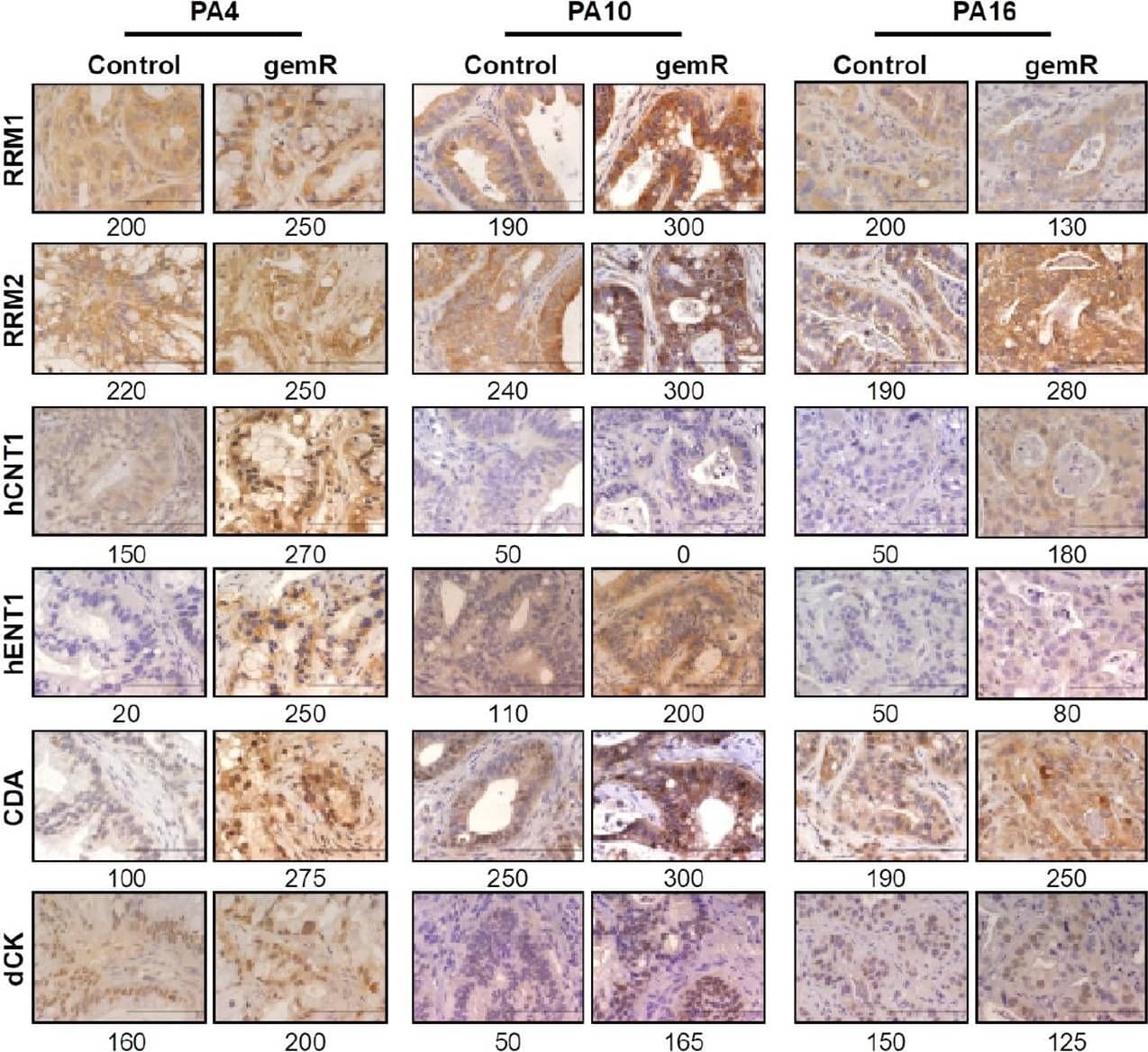 Immunohistochemistry: SLC28A1 Antibody [NBP2-30857] - PDAC PDX models of acquired gemcitabine resistance harbored changes in expression of some gemcitabine transporters & metabolizing enzymes. Tumor tissue harvested on days 190, 120, & 179 for PA4.gemR, PA10.gemR & PA16.gemR, respectively, was immunostained for RRM1, RRM2, hCNT1, hENT1, CDA, & dCK. Tumor tissue harvested from control mice bearing gemcitabine-naïve PA4, PA10 or PA16 tumors served as controls for IHC staining experiments. Scale bar = 10 μm. Quantitation of IHC data in A is shown as expression indices below each photomicrograph (A); protein expression in gemR models that were developed by exposure to drug in vivo, compared to their respective parent tumor models. Each protein has been reported to be associated with gemcitabine resistance in models developed in vitro. ND: no difference between gemcitabine-naïve control & gemR tumors. Values in the Table were calculated by dividing the EI of each protein determined by IHC expressed by gemR/parent (control) tumors. A change of > 1.5-fold was interpreted as a real increase or decrease (B). PDAC: pancreatic ductal adenocarcinoma; PDX: patient-derived xenograft; gemR: gemcitabine resistance; IHC: immunohistochemistry Image collected & cropped by CiteAb from the following publication (//pubmed.ncbi.nlm.nih.gov/33073205), licensed under a CC-BY license. Not internally tested by Novus Biologicals.