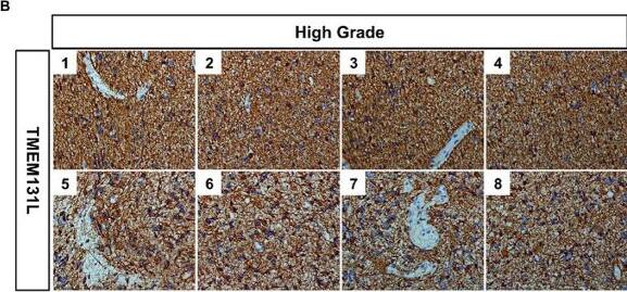 TMEM131L is elevated in glioma. (A) Expression of TMEM131L in low-grade gliomas (n = 8); (B) Expression of TMEM131L in high-grade gliomas (n = 8); (C,D) The mRNA and protein expression of TMEM131L in low-grade and high-grade gliomas was quantified (n = 6); (E) Detection and quantification of interference efficiency of si-TMEM131L-1 and si-TMEM131L-2 (n = 6). n.s > 0.05, ****p ≤ 0.0001. Image collected and cropped by CiteAb from the following open publication (//pubmed.ncbi.nlm.nih.gov/37090987), licensed under a CC-BY license. Not internally tested by Novus Biologicals.
