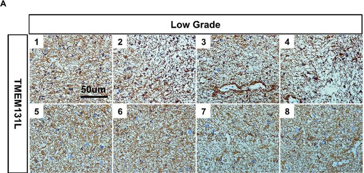 TMEM131L is elevated in glioma. (A) Expression of TMEM131L in low-grade gliomas (n = 8); (B) Expression of TMEM131L in high-grade gliomas (n = 8); (C,D) The mRNA and protein expression of TMEM131L in low-grade and high-grade gliomas was quantified (n = 6); (E) Detection and quantification of interference efficiency of si-TMEM131L-1 and si-TMEM131L-2 (n = 6). n.s > 0.05, ****p ≤ 0.0001. Image collected and cropped by CiteAb from the following open publication (//pubmed.ncbi.nlm.nih.gov/37090987), licensed under a CC-BY license. Not internally tested by Novus Biologicals.