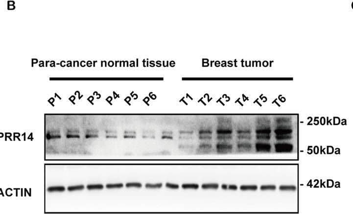 The upregulated expression of PRR14 is confirmed in human breast samples.PRR14 mRNA (a) and protein (b) expression in breast cancer and para-carcinoma breast tissue are detected by qRT-PCR and immunostaining, respectively. The protein level is quantified (c). Both the transcription and expression are normalized by ACTB and statistically analyzed by paired two-tailed Student’s t-test. Representative images of IHC staining for PRR14 with different staining intensity in a human breast cancer tissue microarray are presented (d). The data are presented as the percentage of samples with different PRR14 staining intensity (e, f). Image collected and cropped by CiteAb from the following open publication (//pubmed.ncbi.nlm.nih.gov/32541902), licensed under a CC-BY license. Not internally tested by Novus Biologicals.