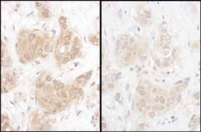 Samples: FFPE serial sections of human breast carcinoma. Antibody: Affinity purified rabbit anti- WWOX (NBP2-32121 left; NBP2-32122 right) used at a dilution of 1:1,000 (1ug/ml). Detection: DAB. Counterstain: Hematoxylin (blue).