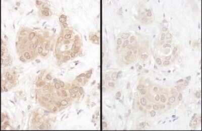 Samples: FFPE serial sections of human breast carcinoma. Antibody: Affinity purified rabbit anti- WWOX (NBP2-32121 left; NBP2-32122 right) used at a dilution of 1:1,000 (1ug/ml). Detection: DAB. Counterstain: Hematoxylin (blue).