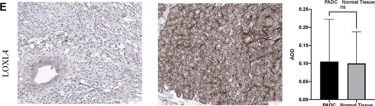 Representative immunohistochemistry of LOXs in PDAC tissues and normal pancreas tissues. (A) IHC staining of LOX and quantification showed higher expression in PDAC than normal pancreas tissues. (B) IHC staining and quantification showed higher expression of LOXL1 in PDAC. (C) IHC staining and quantification showed higher expression of LOXL2 in PDAC. (D) IHC staining and quantification showed lower expression of LOXL3 in PDAC. (E) LOXL4 expression levels were similar in PDAC and normal tissues. *p < 0.01; NS, no significant difference. n = 6, repeated 5 times. Image collected and cropped by CiteAb from the following open publication (//pubmed.ncbi.nlm.nih.gov/35433829), licensed under a CC-BY license. Not internally tested by Novus Biologicals.