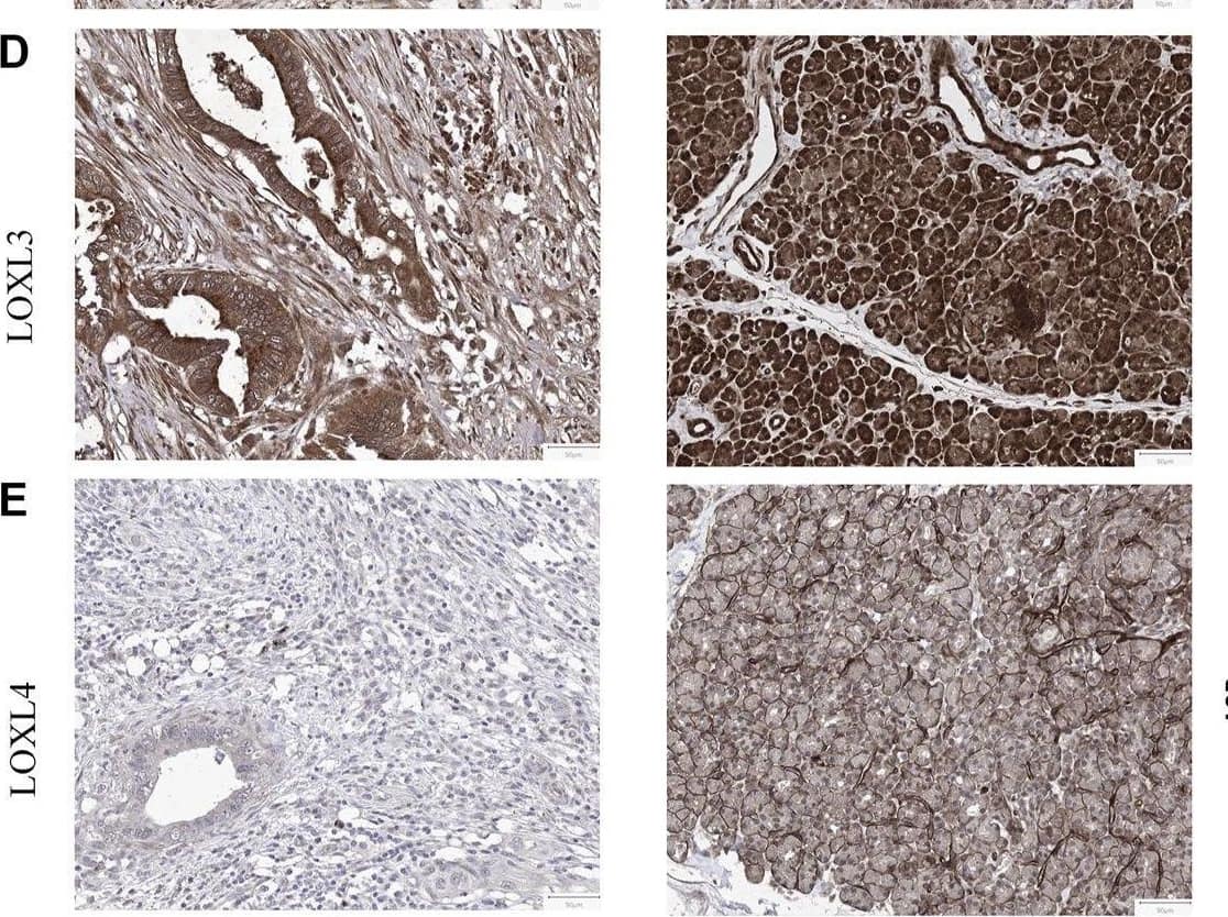 Representative immunohistochemistry of LOXs in PDAC tissues and normal pancreas tissues. (A) IHC staining of LOX and quantification showed higher expression in PDAC than normal pancreas tissues. (B) IHC staining and quantification showed higher expression of LOXL1 in PDAC. (C) IHC staining and quantification showed higher expression of LOXL2 in PDAC. (D) IHC staining and quantification showed lower expression of LOXL3 in PDAC. (E) LOXL4 expression levels were similar in PDAC and normal tissues. *p < 0.01; NS, no significant difference. n = 6, repeated 5 times. Image collected and cropped by CiteAb from the following open publication (//pubmed.ncbi.nlm.nih.gov/35433829), licensed under a CC-BY license. Not internally tested by Novus Biologicals.