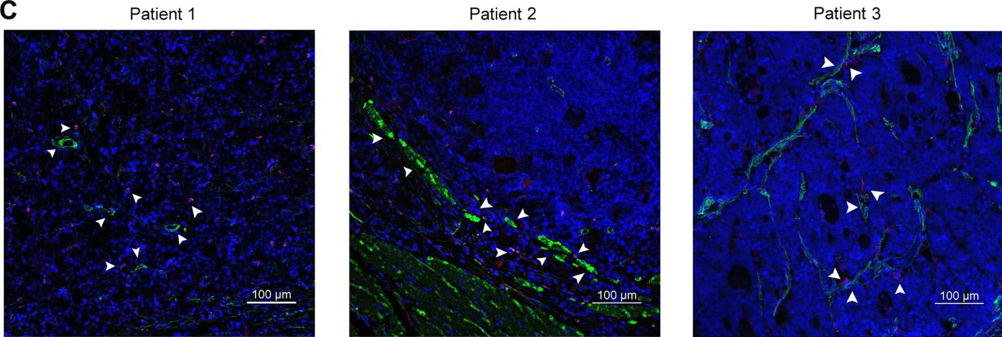 M2 macrophage-related protein expression and the co-location of M2-macrophages and GC-MSCs within tumor tissues.a Expression levels of iNOS, Ym-1, and Fizz-1 mRNA were analyzed by RT-qPCR in tumor tissues and the corresponding adjacent non-cancerous tissues collected randomly from 10 gastric cancer patients. b The expressions of arginase-1 and CCR-2 were assessed by western blot in tumor tissues and the corresponding adjacent non-cancerous tissues collected randomly from 10 gastric cancer patients. c Representative immumofluoresence images of the co-location of GC-MSCs ( alpha -SMA; green) and M2-macrophages (CD204; red) in gastric cancer tissues detected by confocal microscopy. scale bar, 100 um. **P < 0.01 vs. gastric cancer tissue. T: tumor; N: non-cancerous tissues. Image collected and cropped by CiteAb from the following open publication (//pubmed.ncbi.nlm.nih.gov/31801938), licensed under a CC-BY license. Not internally tested by Novus Biologicals.