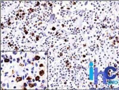 Immunohistochemistry-Paraffin: Lambda Light Chain Antibody (ICO-106) - Azide and BSA Free [NBP2-33308] - Formalin-fixed, paraffin-embedded non-Hodgkin's lymphoma stained with Lambda antibody (1:200), peroxidase-conjugate and DAB chromogen. Note the cell membrane and cytoplasmic staining.