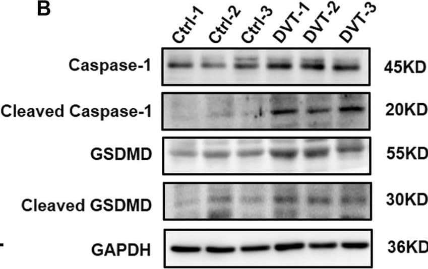Western Blot: GSDMDC1 Antibody [NBP2-33422] - Expressions of caspase-1, GSDMD, IL-1 beta , & IL-18 are up-regulated in DVT patients. (A) mRNA level of caspase-1 in the PBMCs from 30 DVT patients & 30 controls was determined by qRT-PCR. (B) Caspase-1 & GSDMD protein levels were measured in PBMCs of DVT subjects & controls by Western blot. (C,D) Protein levels of IL-1 beta  & IL-18 in the serum from 12 DVT patients & 12 controls were determined by ELISA. ****p < 0.0001. Image collected & cropped by CiteAb from the following publication (//pubmed.ncbi.nlm.nih.gov/35445025), licensed under a CC-BY license. Not internally tested by Novus Biologicals.