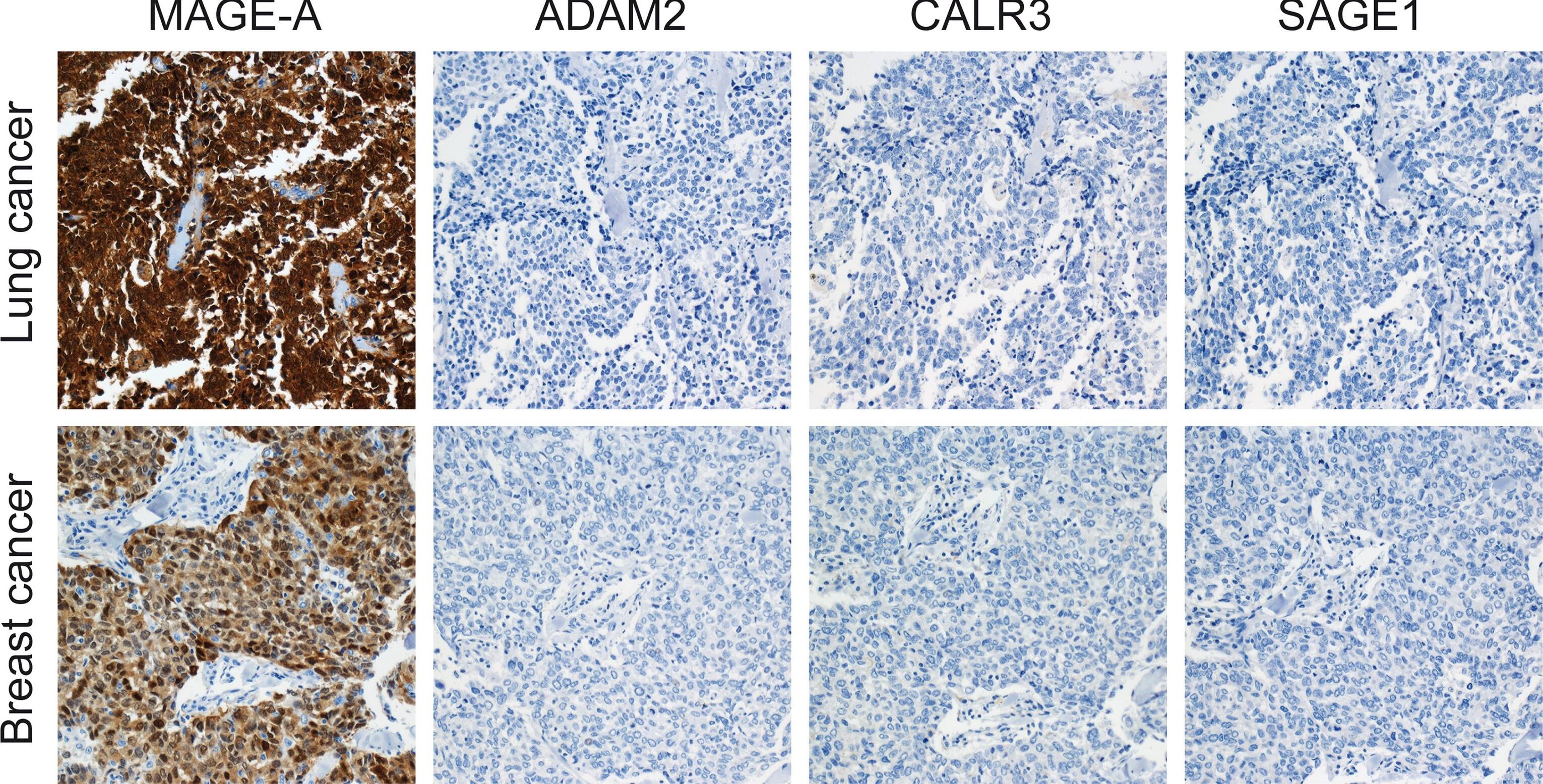 Immunohistochemistry: Calreticulin-2/CALR3 Antibody [NBP2-33524] - Immunohistochemical staining of CT antigens in lung & breast cancer tumors.Examples of lung & breast cancer tumors positive for MAGE-A & negative for ADAM2, CALR3 & SAGE1 (all pictures magnification x20). Image collected & cropped by CiteAb from the following publication (//dx.plos.org/10.1371/journal.pone.0134967), licensed under a CC-BY license. Not internally tested by Novus Biologicals.