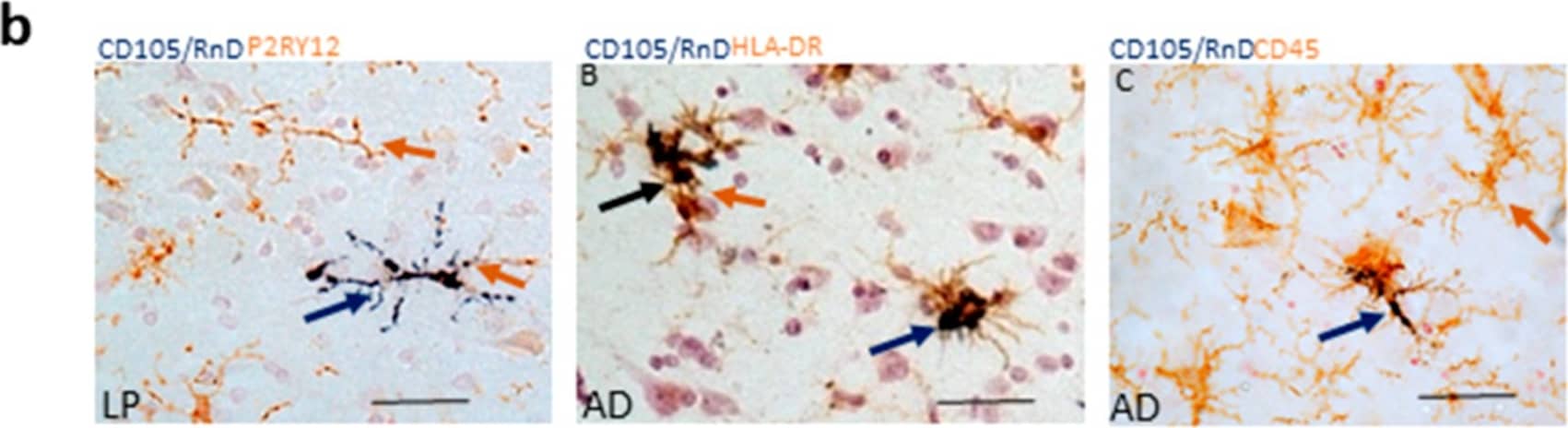 Immunohistochemistry: P2Y12/P2RY12 Antibody [NBP2-33870] - Images demonstrating colocalization of CD105/MAB1097 with microglial markers (a) panels A, B Low magnification images of high-plaque (HP) case (panel A) & AD case (panel B) showing staining with CD105/MAB1097 (purple arrows) & IBA-1 (brown arrows) in MTG sections. Both images at same magnification: scale bars represent 100 μm. (b) (panel A) CD105 microglia (purple arrows) with ramified morphology stained with antibody to P2RY12 (brown arrow) in low-plaque (LP) case. (panel B) CD105 microglia (purple arrows) & HLA-DR (brown arrow) in AD case. (panel C) CD105 microglia (purple arrow) & CD45 (brown arrow) in AD case. All sections were from MTG. Images at same magnification: scale bars represent 50 μm. (c) (panel A–E). Patterns of staining of CD105 (purple) & IBA-1 (brown) in MTG sections of cases with progressively increasing pathology from LP to AD. (panel F). CD105-positive microglia in hippocampus (HPC) of AD case. Images at same magnification: scale bars represent 50 μm. Image collected & cropped by CiteAb from the following publication (//pubmed.ncbi.nlm.nih.gov/31340569), licensed under a CC-BY license. Not internally tested by Novus Biologicals.