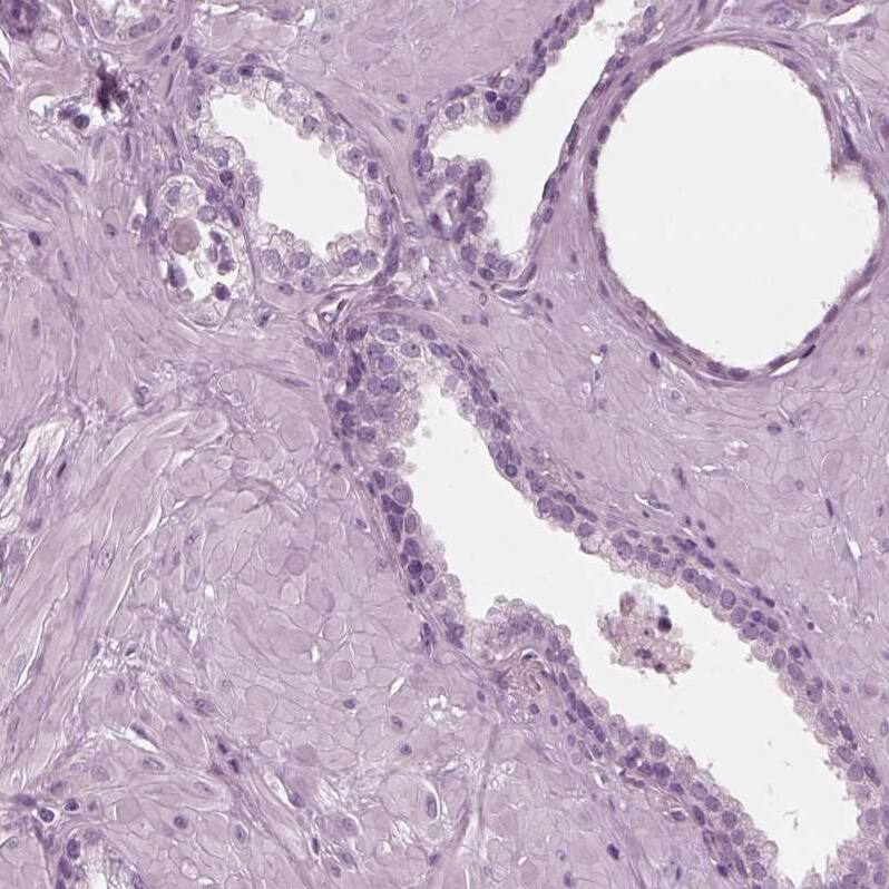 Staining of human prostate shows no positivity in glandular cells as expected.