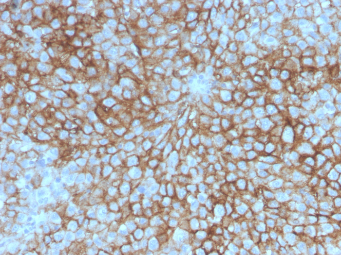 Formalin-fixed, paraffin-embedded human melanoma stained with MCAM/CD146 antibody (OJ79c). HIER: Tris/EDTA, pH9.0, 45min. Secondary: HRP-polymer, 30min. DAB, 5min.