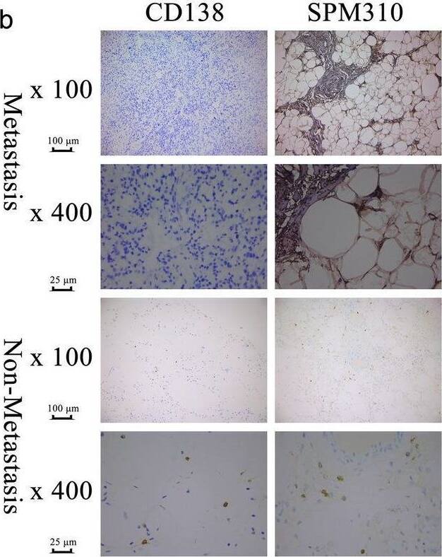 The results of immunohistochemistry (IHC). In total of 29 patients, 15 were diagnosed with liposarcoma (Metastasis occurred in eight patients during follow-up) and 14 were diagnosed with leiomyosarcoma (Metastasis occurred in nine patients during follow-up). Proteins of PAX5 and LTB were shown to be significantly down-regulated in the tumor cells of primary sarcomas with metastasis while the markers of B cells (CD19 and CD 38) were not detected in almost all primary tumor (a). Although CD19 and CD 38 were found in lymph node, as the advice of a pathologist in our hospital, these were not surprising as B cells are abundant in lymph node. Therefore, the IHC results of CD19 and CD 38 did not prove or disprove the hypothesis. Furthermore, in the absence of a good CD19 and CD38 antibody, we considered CD138 (Syndean-1) and SPM310 plasma cell marker antibody (Novus NBP2-34359) as other proven plasma cell markers. However, only four of 29 sarcomas were found plasma cells in the HE staining section of the tumor and none of the four patients had metastases (b). This might be because tumor-infiltrating immune cells tended to be located around the tumor rather than within it, and sarcomas tended to be excised en bloc, so there were no paracancer tissues as a control. Fortunately, the results of Mann–Whitney U test suggested that PAX5 (P < 0.001), LTB (P < 0.001) in were all highly expressed in well differentiated primary sarcomas and primary sarcomas without metastasis (c, d) Image collected and cropped by CiteAb from the following open publication (//pubmed.ncbi.nlm.nih.gov/33397394), licensed under a CC-BY license. Not internally tested by Novus Biologicals.