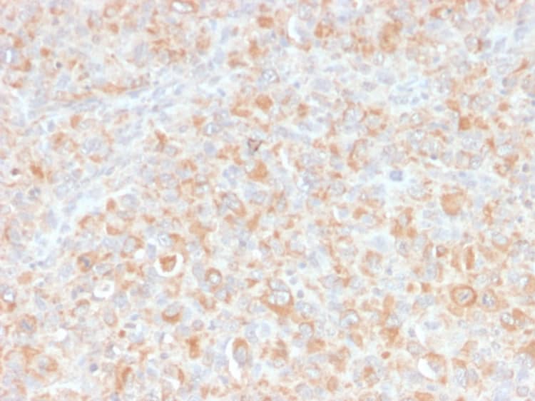 Formalin-fixed, paraffin-embedded human histiocytoma stained with TNF-alpha Antibody (SPM543) - Azide and BSA Free.