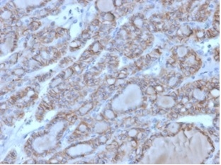 Formalin-fixed, paraffin-embedded human thyroid stained with NCAM-1/CD56 antibody (123A8 (same as 56C04)). HIER: Tris/EDTA, pH9.0, 45min. Secondary: HRP-polymer, 30min. DAB, 5min.