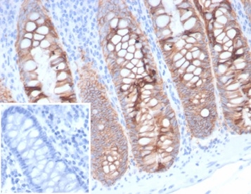 Formalin-fixed, paraffin-embedded human colon stained with EpCAM/TROP1 antibody (323/A3) - (ECD). Inset: PBS instead of primary antibody; secondary only negative control.
