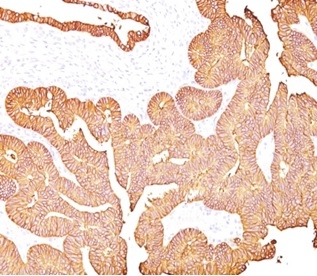 Formalin-fixed, paraffin-embedded human colon carcinoma stained with EpCAM/TROP1 antibody (323/A3) - (ECD). HIER: Tris/EDTA, pH9.0, 45min. Secondary: HRP-polymer, 30min. DAB, 5min.