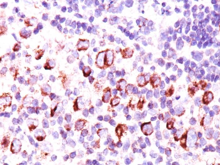 Formalin-fixed, paraffin-embedded Hodgkin's lymphoma stained with bcl-x Antibody (BX006 + 2H12) - Azide and BSA Free.