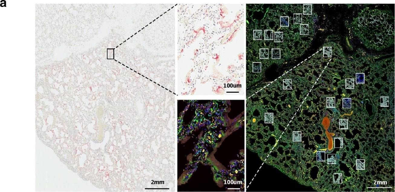 Immunocytochemistry/ Immunofluorescence: CD68/SR-D1 Antibody (SPM130) [Alexa Fluor® 647] [NBP2-34736AF647] - Intrapulmonary heterogeneity of SARS-CoV-2 host response.a Selection of ROIs. Left) SARS-CoV-2 RNA-ISH staining was used to guide ROI selection of viral positive & viral negative regions. (Scale bar = 2 mm). Right) multi-color immunofluorescence staining for CD45/red, CD68/yellow, PanCK/green, & DNA/blue were used in parallel to select ROIs. (Scale bar = 2 mm). Example ROIs are shown in insets. (Scale bar = 100 μm). b Distribution of immune subsets & relationship with viral location. Rows show estimates from distinct cell types; columns show distinct tissues. Point position shows the physical location of regions within each tissue. Point size shows a cell type’s estimated proportion of cells in a region. Point color denotes whether a region was classified SARS-CoV-2 positive or negative by RNA-ISH. c tSNE clustering of geometric ROIs highlights two primary clusters exist within the data irrespective of SARS-CoV-2 RNA-ISH status of ROI or patient viral load. d Differential expression analysis of clusters identified by tSNE analysis. Target genes colored by significance & association with tSNE clusters. Targets with FDR < 0.05 are shown in gray. Genes shown in red are associated with higher expression cluster labeled ‘active’ in panel (c); genes shown in blue are associated with higher expression in the cluster labeled ‘inactive’. e Unsupervised clustering analysis of interferon stimulated genes cluster across ROIs. Annotation by patient sample identifier & SARS-CoV-2 RNA-ISH positivity in the ROI as performed by GeoMx Digital Spatial Profiler. Source data are provided as a Source data file. Image collected & cropped by CiteAb from the following publication (//pubmed.ncbi.nlm.nih.gov/33298930), licensed under a CC-BY license. Not internally tested by Novus Biologicals.