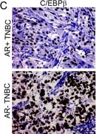 AR may repress C/EBP beta  expression in breast cancer. (A–B, D) Correlation matrix of AR and C/EBP beta  mRNA levels in TCGA (A), CCLE (B), and Emory Decatur (D) datasets. (C, F) Representative IHC images (C) and bar graphs (F) showing the expression of C/EBP beta  in patients with AR + TNBC (n = 21) and AR-TNBC (n = 58) in the Emory Decatur cohort. (G, H) ChIP results showing AR binding to the C/EBP beta  promoter (G). (E) Bar graphs showing mRNA levels of C/EBP beta  in AR + TNBC and AR-TNBC cell lines. (I) Immunoblots showing C/EBP beta  expression levels in AR + TNBC and AR-TNBC cell lines. (J, K) Schematic and bar graphs showing luciferase assay in AR + TNBC and AR-TNBC cells. HCC70, MFM223 (AR + TNBC); 3, 4: HCC1806, BT20 (AR-TNBC). Bars indicate mean +/- SEM. Unpaired two-tailed Student’s t-test with Welch’s correction was used to determine statistical significance. **P < 0.005, ***P < 0.0005, ns = non-significant Image collected and cropped by CiteAb from the following open publication (//pubmed.ncbi.nlm.nih.gov/40448099), licensed under a CC-BY license. Not internally tested by Novus Biologicals.