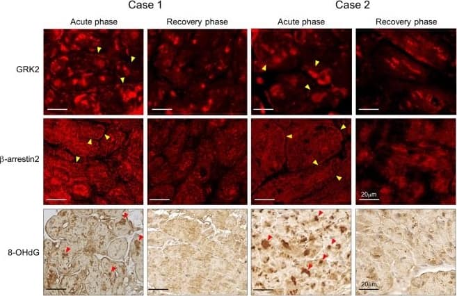 Immunocytochemistry/ Immunofluorescence: GRK2 Antibody (3F8) - BSA Free [NBP2-37611] - Localization of G protein-coupled receptor kinase 2 (GRK2),  beta -arrestin2, & 8-hydroxy-2′deoxyguanosine (8-OHdG) in two patients with takotsubo syndrome who underwent endomyocardial biopsy in both the acute & recovery phases. Micrographs showing immunofluorescence stainings of GRK2 &  beta -arrestin2, & immunohistochemical staining of 8-OHdG in the acute & recovery phases. Arrowheads (yellow) indicate positive signals for GRK2 &  beta -arrestin2 on the cell membrane, & Arrowheads (red) indicate 8-OHdG-positive nuclei. Image collected & cropped by CiteAb from the following publication (//pubmed.ncbi.nlm.nih.gov/30143703), licensed under a CC-BY license. Not internally tested by Novus Biologicals.