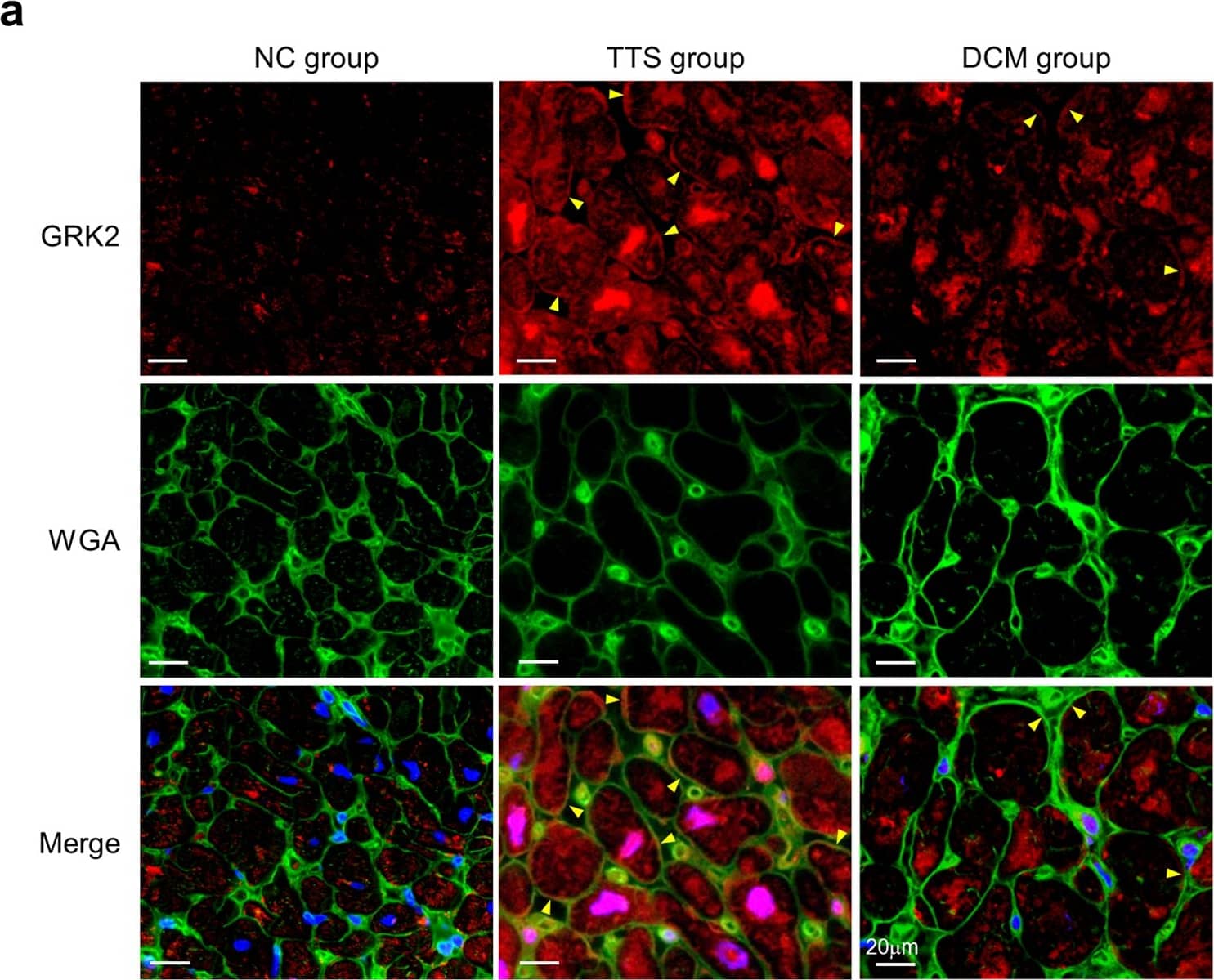 Immunocytochemistry/ Immunofluorescence: GRK2 Antibody (3F8) - BSA Free [NBP2-37611] - Localization of G protein-coupled receptor kinase 2 (GRK2). (a) Immunohistofluorescence staining for GRK2 using the specific antibody. GRK2 (red) in the takotsubo syndrome (TTS) & dilated cardiomyopathy (DCM) groups were observed not only in the cytoplasm but also on the cell membrane, which was confirmed by colocalization with wheat germ agglutinin (WGA) (green) (Arrowheads). Blue staining localized to 4′,6-diamidino-2-phenylindole (DAPI). (b) Quantification for GRK2 positive stained area in the myocardium. The box represents the 25th & 75th percentiles & the line the median value. Whiskers correspond to the 25th percentile minus 1.5 times interquartile range (IQR) & to the 75th percentile plus 1.5 IQR. (c) Quantification for membranous GRK2 positive cardiomyocyte. *P < 0.001 vs. the normal control (NC) group. †P < 0.001 vs. the DCM group. Image collected & cropped by CiteAb from the following publication (//pubmed.ncbi.nlm.nih.gov/30143703), licensed under a CC-BY license. Not internally tested by Novus Biologicals.