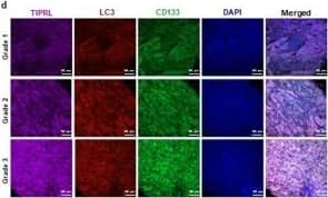 Immunocytochemistry/ Immunofluorescence: CD133 Antibody (3F10) - BSA Free [NBP2-37741] - Significant correlations between levels of TIPRL, LC3 & CD133 in liver cancers. (a–c) The statistically significant associations between levels of TIPRL, LC3 & CD133 in each grade of liver cancers were determined by the Spearman correlation. Each dot indicates a single patient. (d) The representative images were selected from each grade of human liver cancer tissues that were stained with indicated antibodies. DAPI was used for nucleus staining, & scar bar, 100 μm. (e) Quantitative analyses of TIPRL, LC3 & CD133 were conducted according to each grade of liver cancers. (n), the number of samples is indicated. Image collected & cropped by CiteAb from the following publication (//pubmed.ncbi.nlm.nih.gov/31727942), licensed under a CC-BY license. Not internally tested by Novus Biologicals.